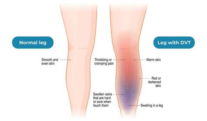 Are cellulitis and DVT related?