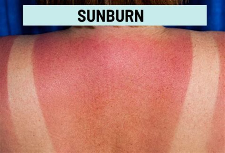 Can a sunburn bruise?