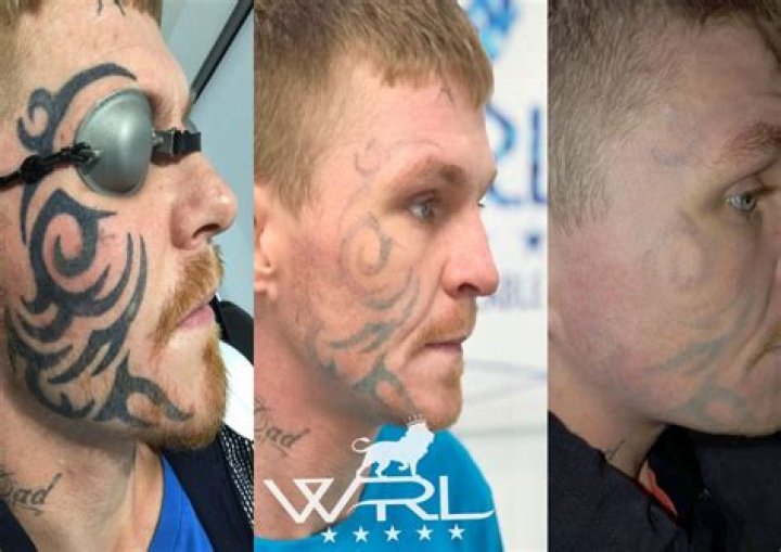 Can you get face tattoos removed?