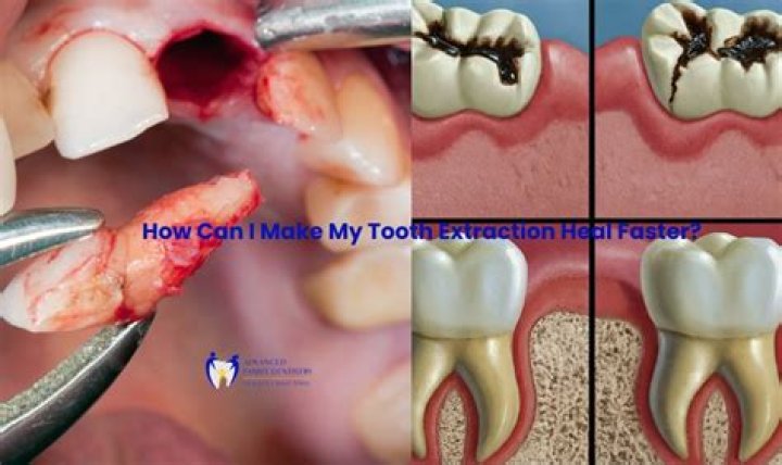How do you stop excessive bleeding after tooth extraction?