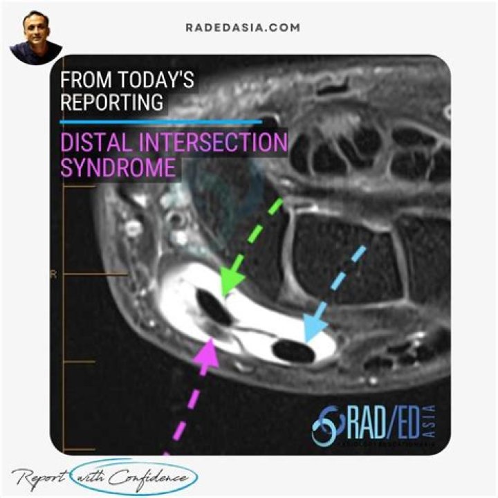 How do you treat intersection syndrome?