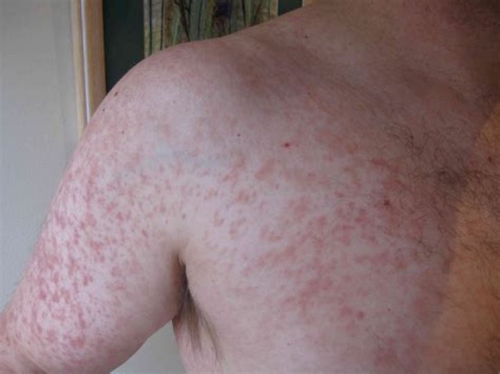 Is a viral Exanthem contagious?