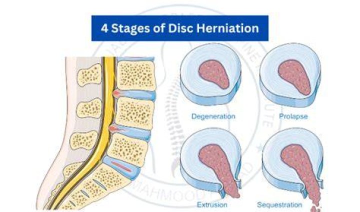 Is it OK to run with a herniated disc?