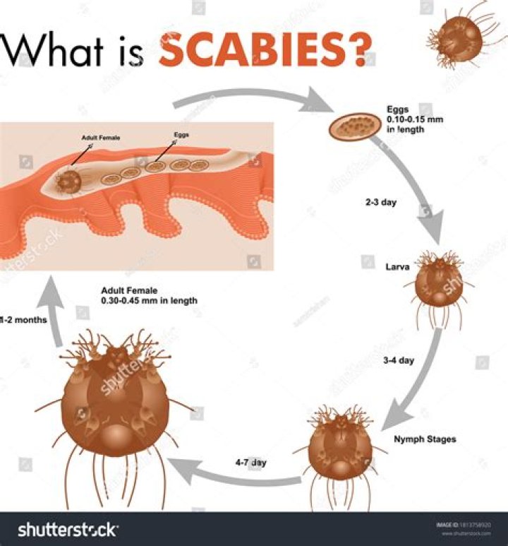 Is scabies only sexually transmitted?