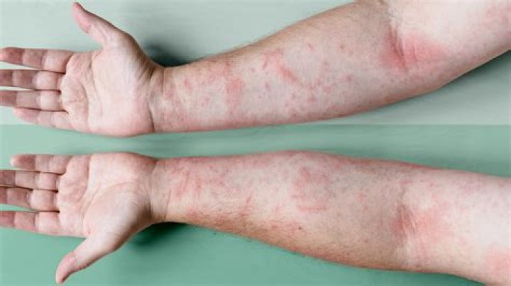 What causes eczematous dermatitis? | ContextResponse.com