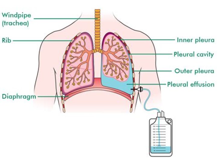 What causes fluid in lungs?