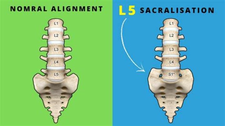 What causes sacralization of l5?