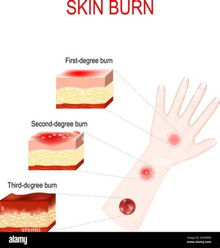 What does a 3rd degree burn look like?