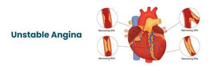What does unstable angina feel like?
