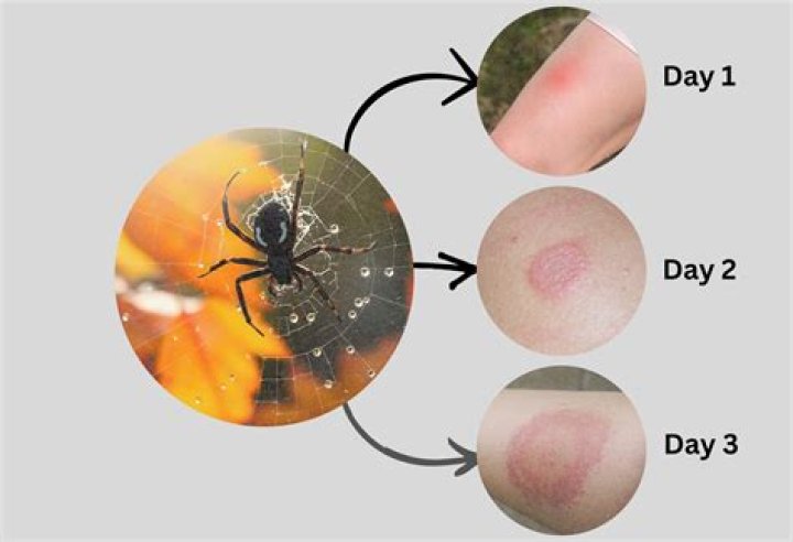What insect bites cause itching?