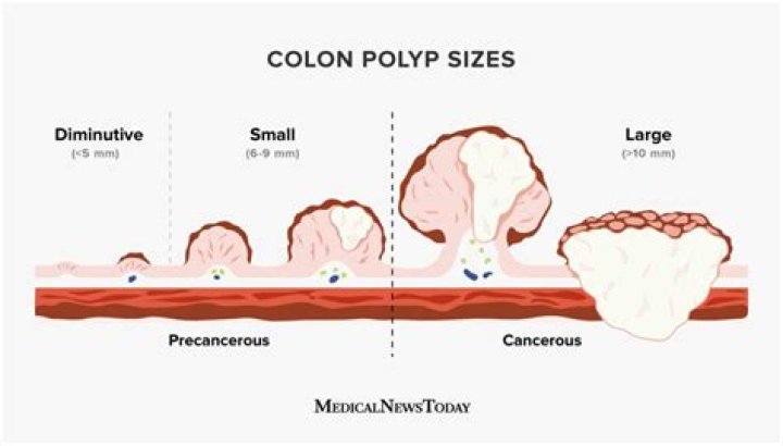 What size is considered a large colon polyp?
